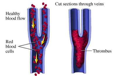 dvt