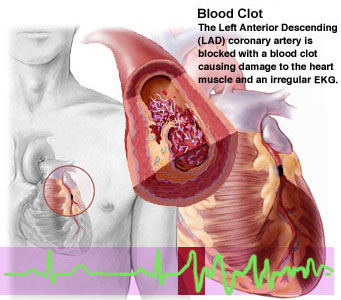 heart attack