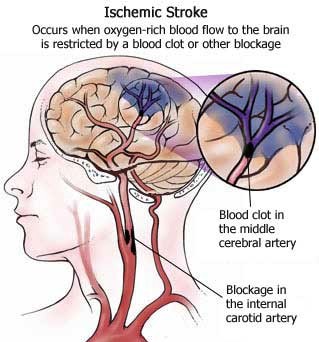 stroke